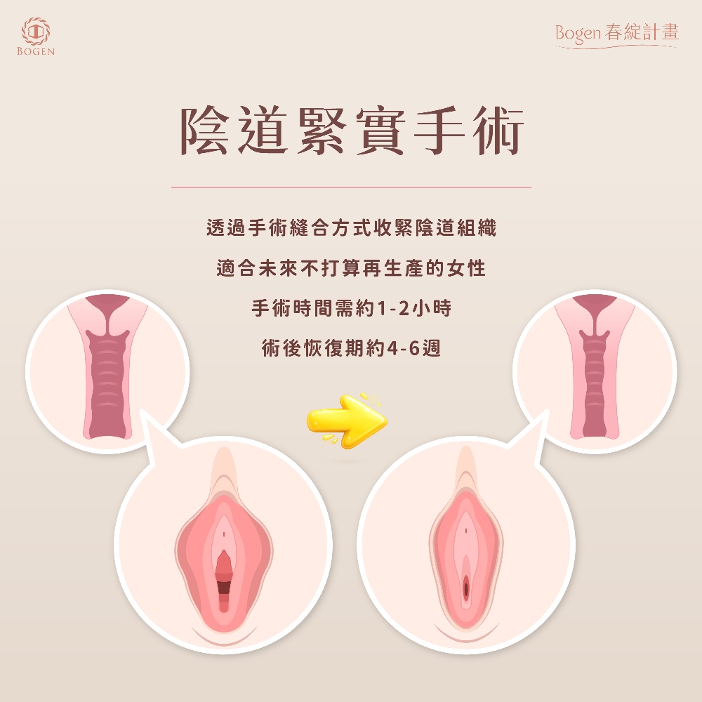 陰道緊實手術,陰道緊實,博恩妍